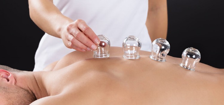 Cupping